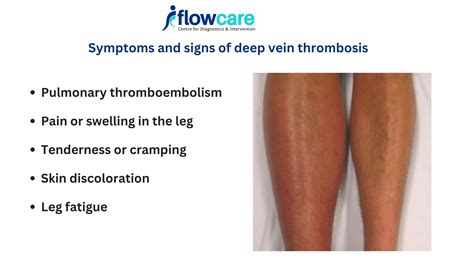 Deep Vein Thrombosis: Victor Wembanyama