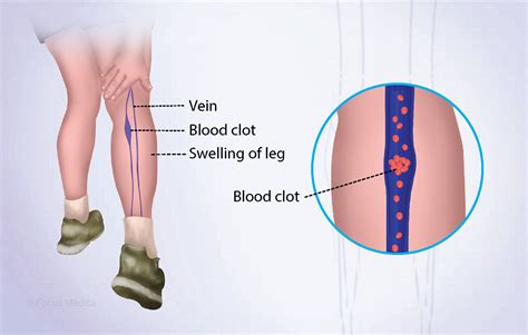 Understanding Wembanyama's DVT Diagnosis