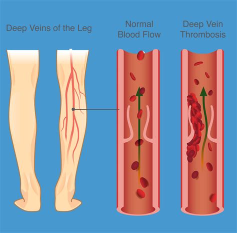 Wembanyama's DVT: Impact And Recovery